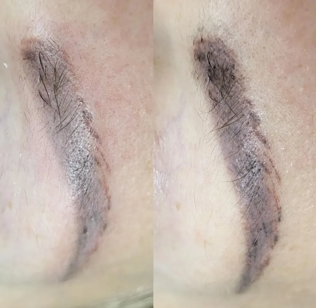 laser tattoo removal melbourne