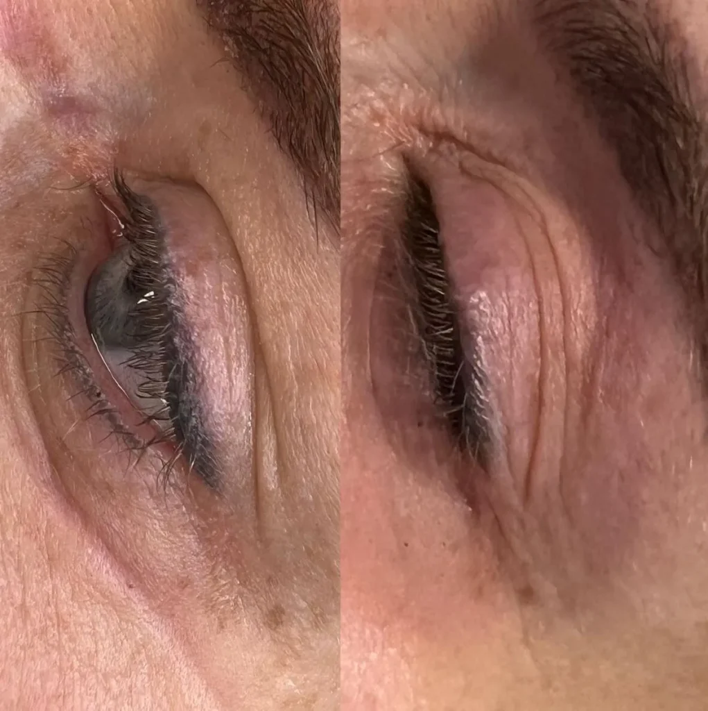 tattoo laser removal