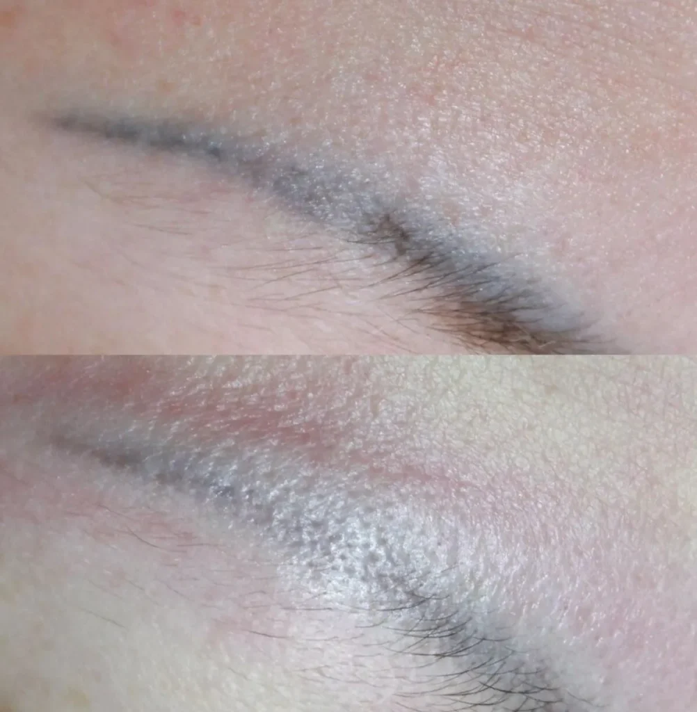 laser tattoo removal near me