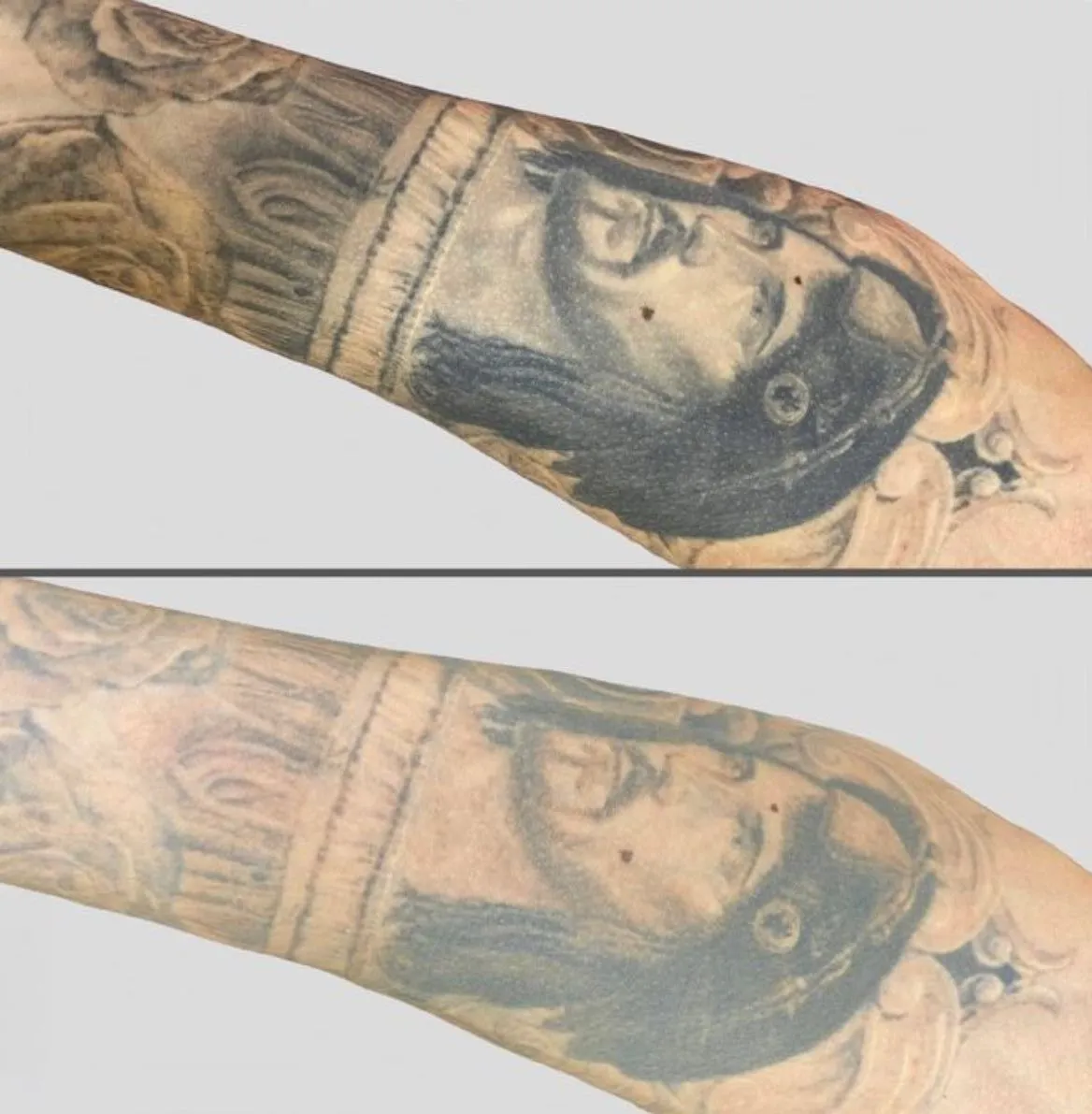 How Laser Tattoo Removal Affects Your Skin’s Pigmentation