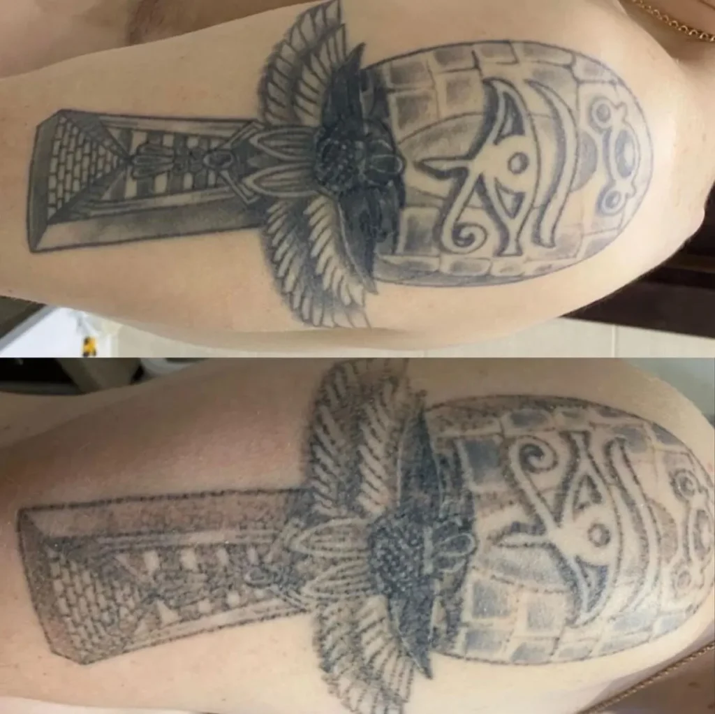 laser tattoo removal cost