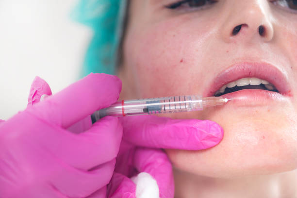 How Long Does It Take for Swelling to Go Down After Lip Filler?