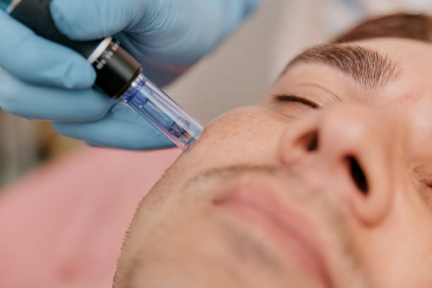 Unlocking Radiance: Microneedling in Australia – Your Ultimate Guide