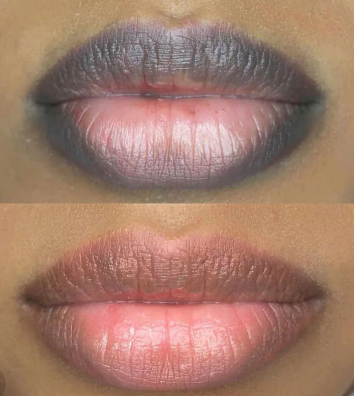 lip neutralisation